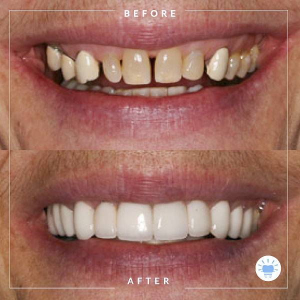 before-after-westmountdentist-2-Edit