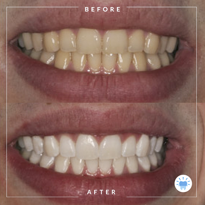 before-after-westmountdentist3-Edit