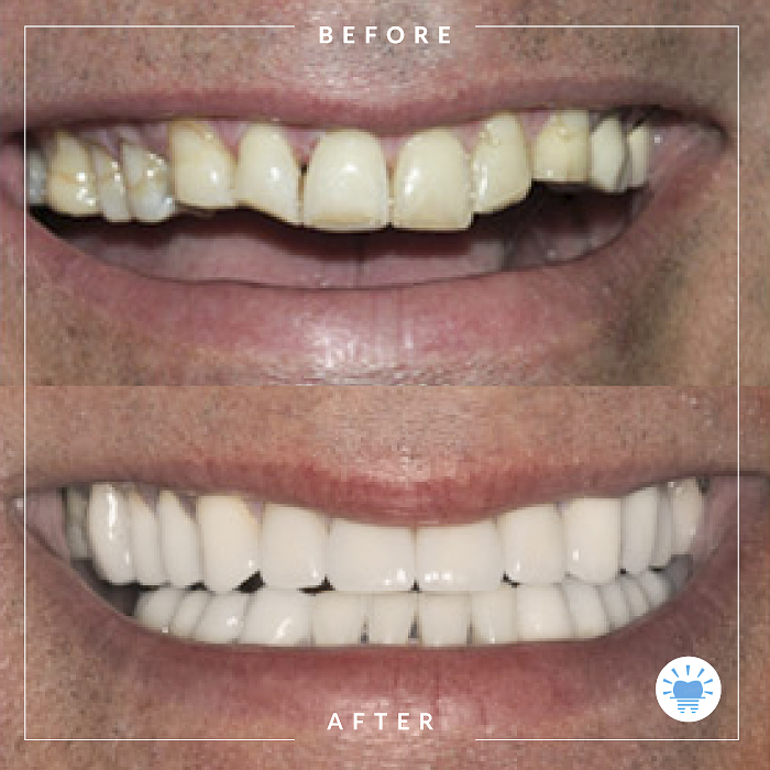 before-after-westmountdentist4-Edit