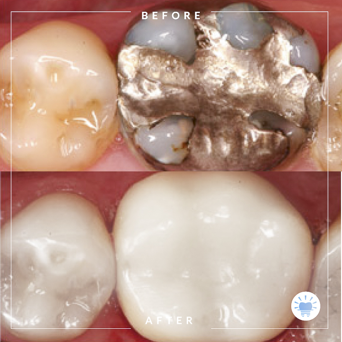 before-after-westmountdentist7-Edit