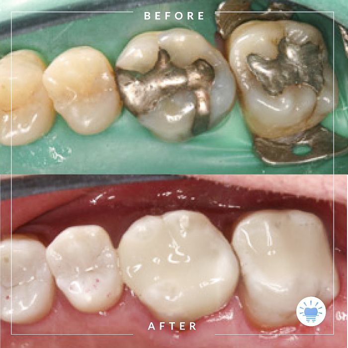 before-after-westmountdentist8-Edit