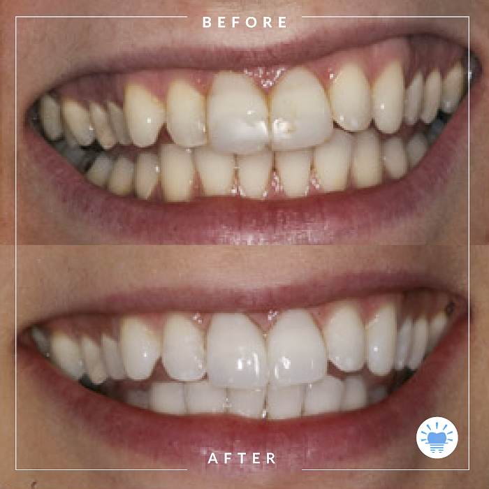 before-after-westmountdentist6-Edit